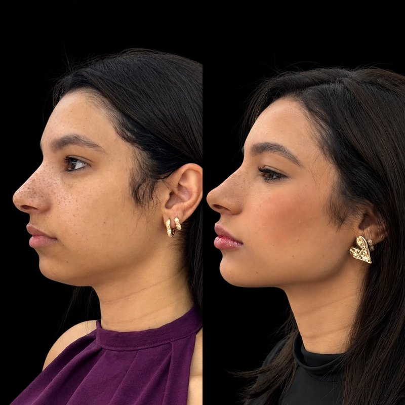 Antes do procedimento, rosto de perfil, fundo preto. Depois do procedimento, no mesmo perfil e no mesmo fundo.