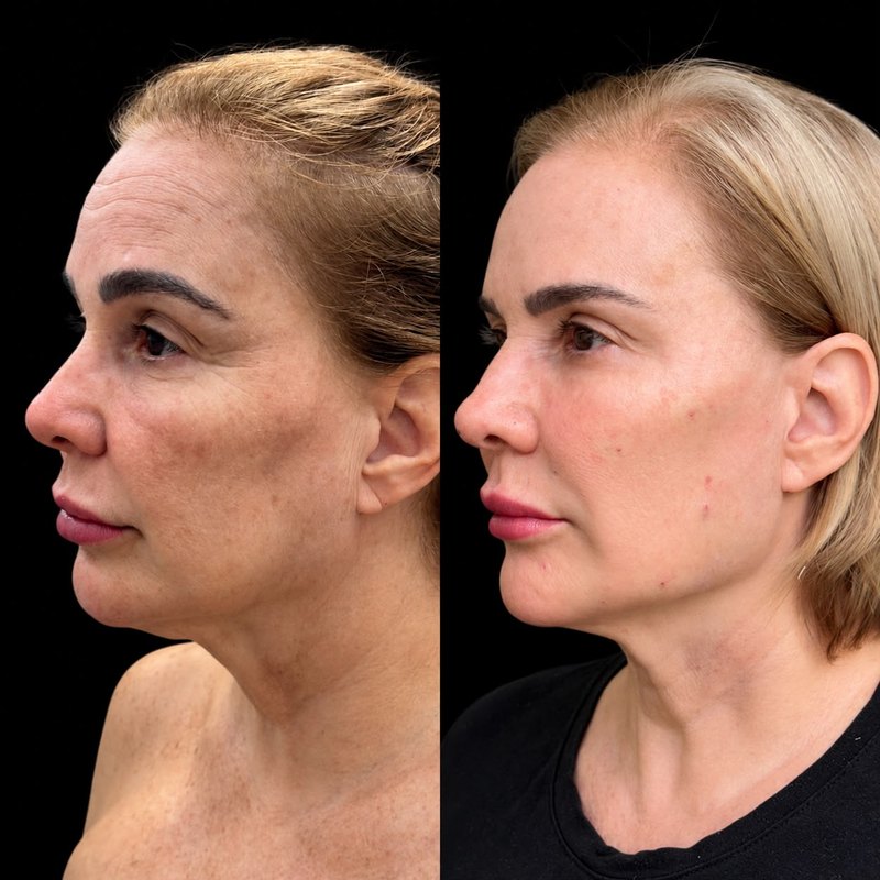 Antes do procedimento, rosto de perfil, fundo preto. Depois do procedimento, no mesmo perfil e no mesmo fundo.