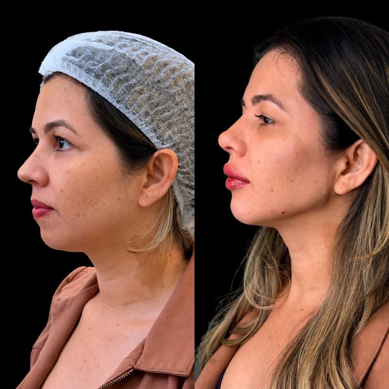 Antes do procedimento, rosto de perfil, fundo preto. Depois do procedimento, no mesmo perfil e no mesmo fundo.