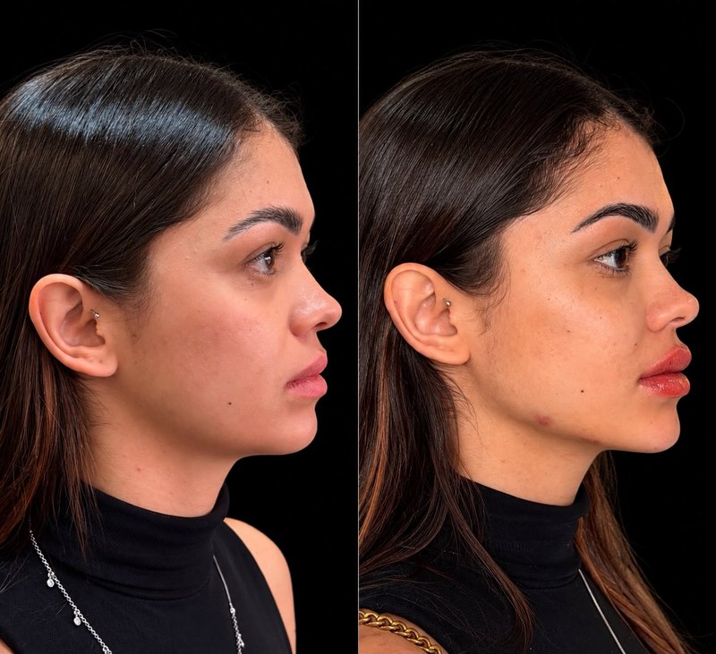 Antes do procedimento, rosto de perfil, fundo preto. Depois do procedimento, no mesmo perfil e no mesmo fundo.